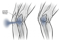 پرتودرمانی، درد ناشی از شایع‌ترین نوع آرتروز رو کم می‌کونه